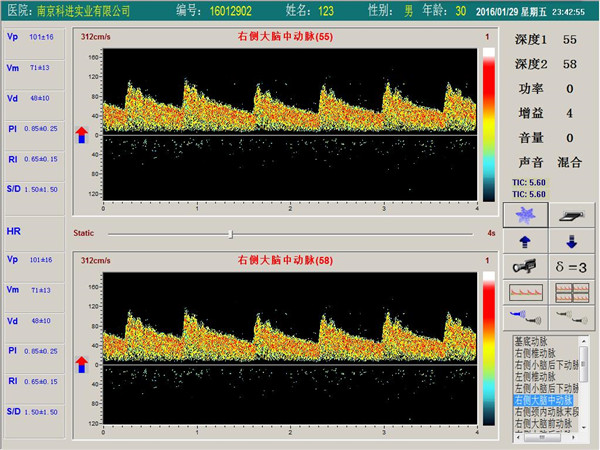 經(jīng)顱多普勒單通道，雙深度界面